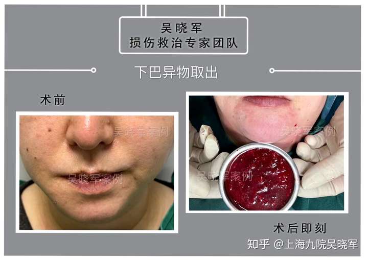 下巴异物取出 - 知乎