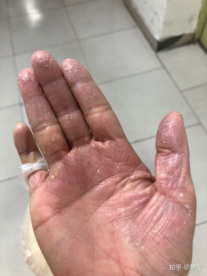 手上湿疹要怎么治