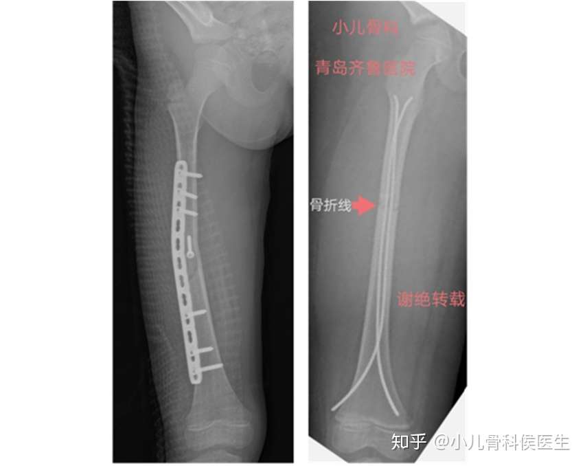 儿童骨折了怎么办 知乎