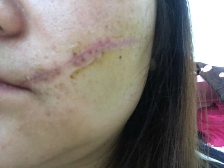 我合适什么样的疤痕修复方法,什么时候可以做?