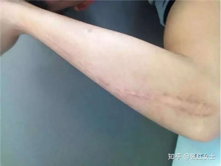 疤痕科普你想过如何应对手术后留下的疤痕吗