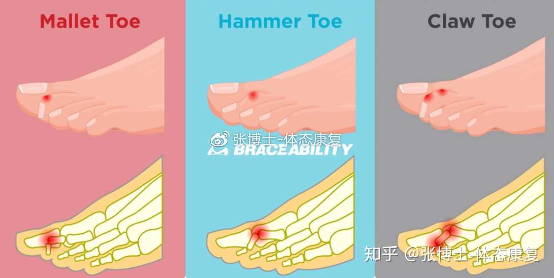 体态矫正 锤状 爪状 槌状趾是什么 足趾畸形的矫正训练 知乎