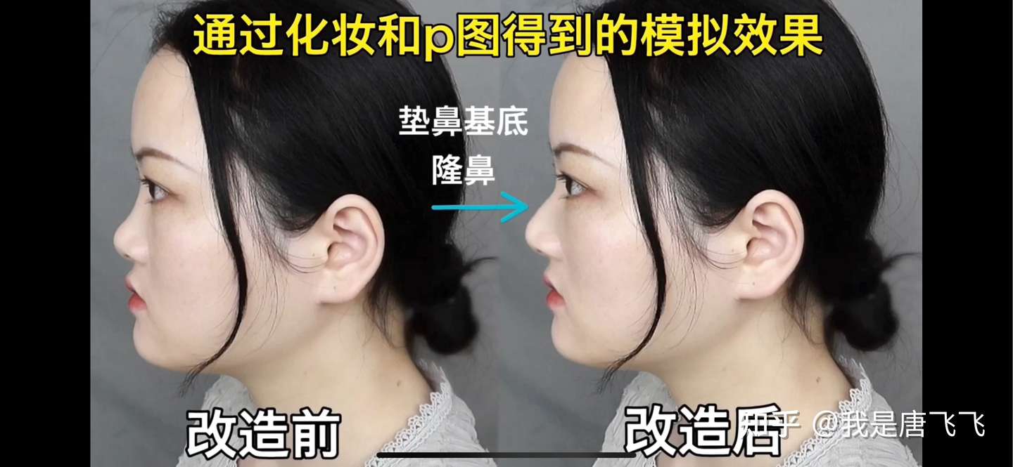 颜值分析 如何拯救一个极丑的鼻子 鼻整形必看 知乎