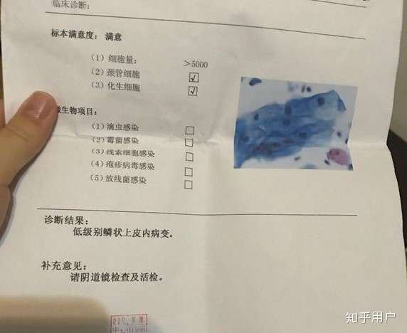hpv611阳性尖锐湿疣如果只想用外用药可以依靠内服达到痊愈么