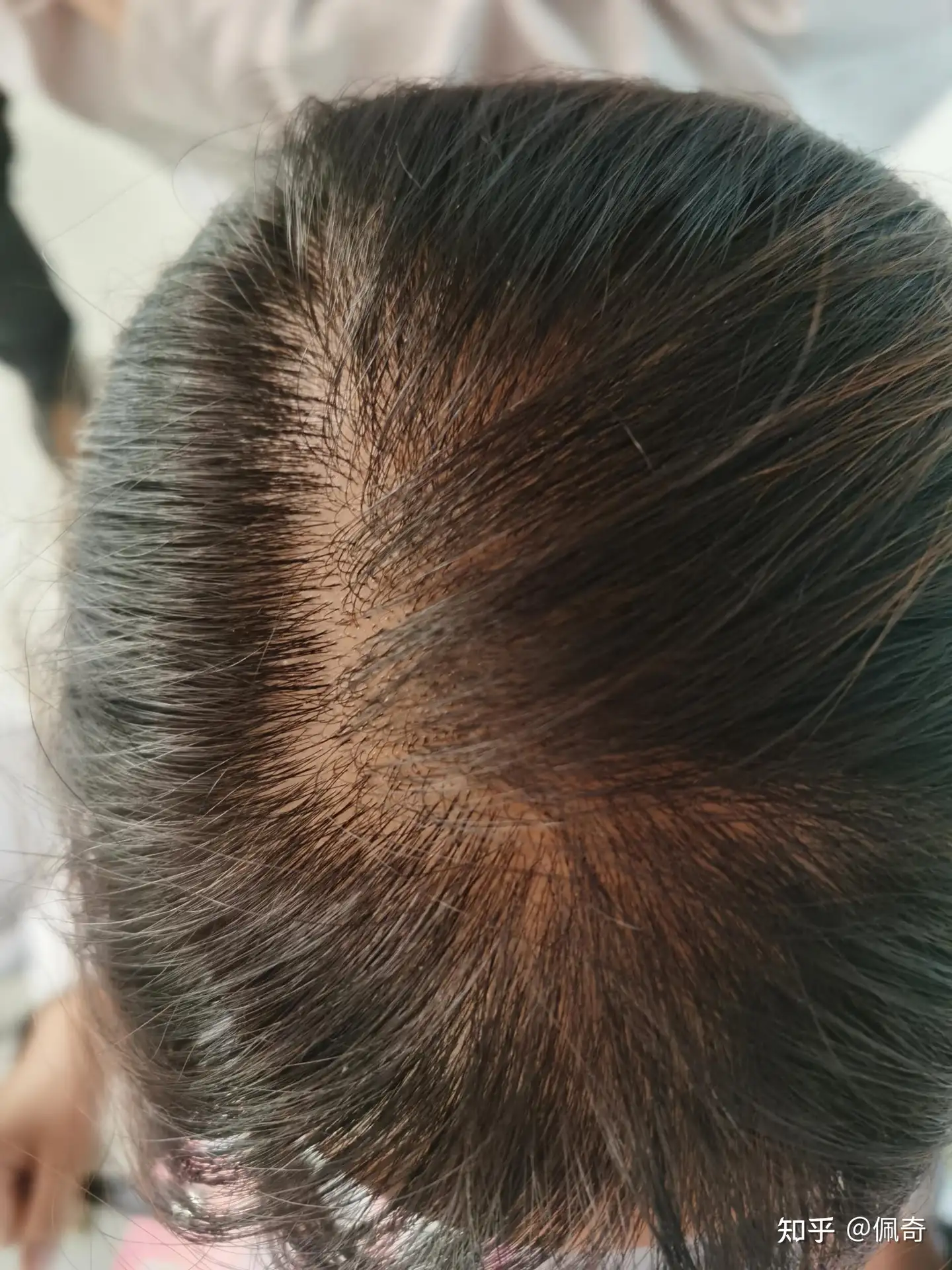 我是女生 开始脱发了 我该怎么办 谈谈女性脱发 知乎