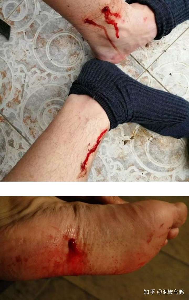 100条活水蛭比较危险,还是100条无毒蛇比较危险?