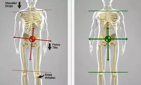 骨盆倾斜如何矫正