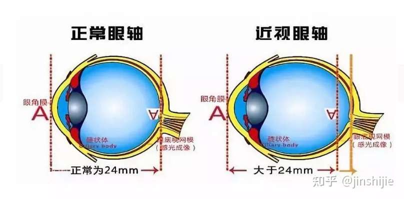 近视与眼轴的关系 知乎