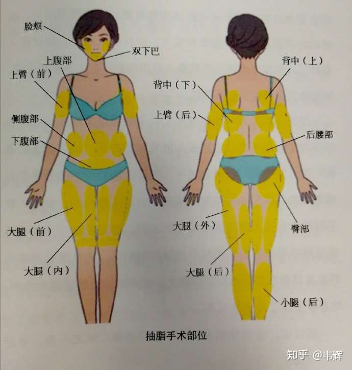 任何肥胖部位都可以吸脂?