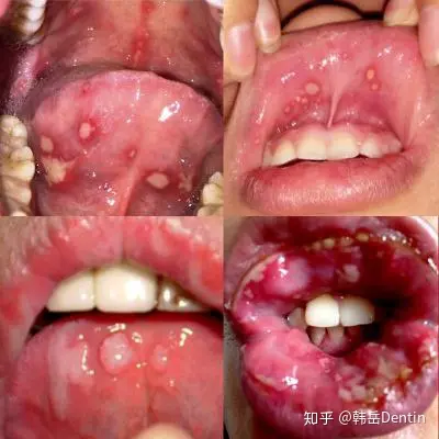 (rou),是最常见的口腔黏膜溃疡类疾病,临床多称复发性阿弗他溃疡(rau)