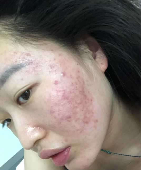 感觉红痘印消不掉啊?