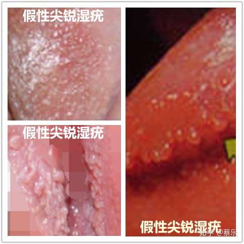 淘宝上卖的祛假性湿疣的药水管用吗,可以尝试吗?