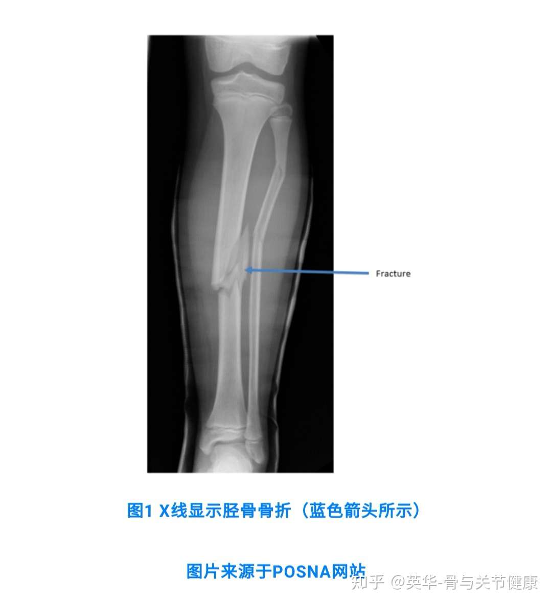 胫骨骨折tibial Shaft Fractures 知乎