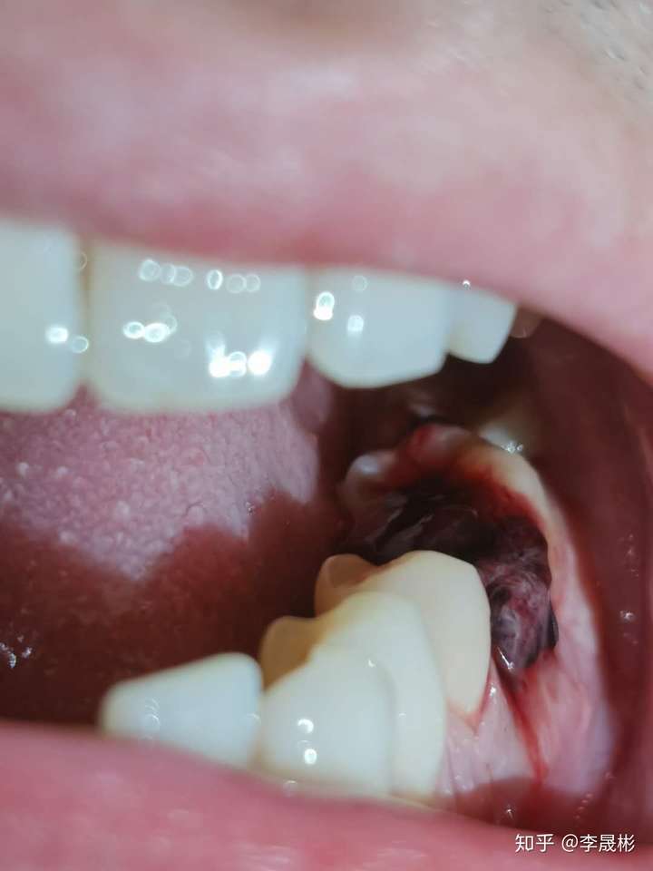 拔完牙的血凝块的图片图片