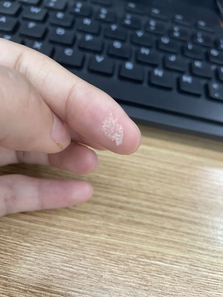 见过的最大头皮屑多大? - 知乎