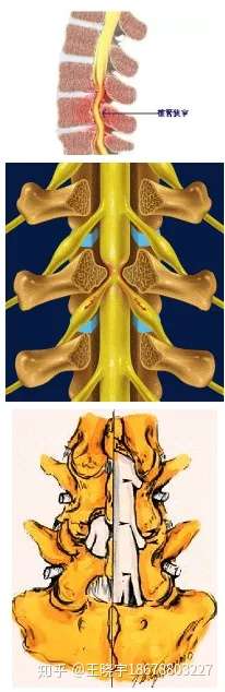 关于腰椎管狭窄症 这篇文章讲得太全面了 医术苑 Be Allspine 医术苑 知乎