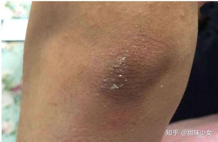 胳膊肘黑洗澡搓不掉怎么办