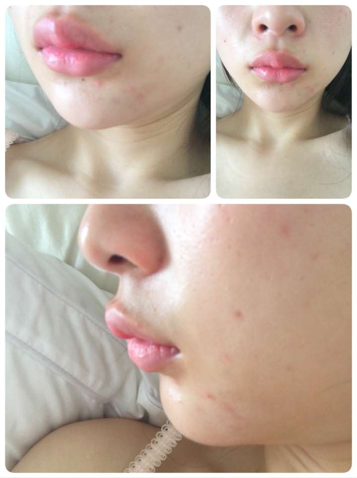 上嘴唇上翘上翻怎么办侧面看起来简直丑哭我