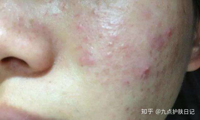 脸部营养过剩应该怎么办