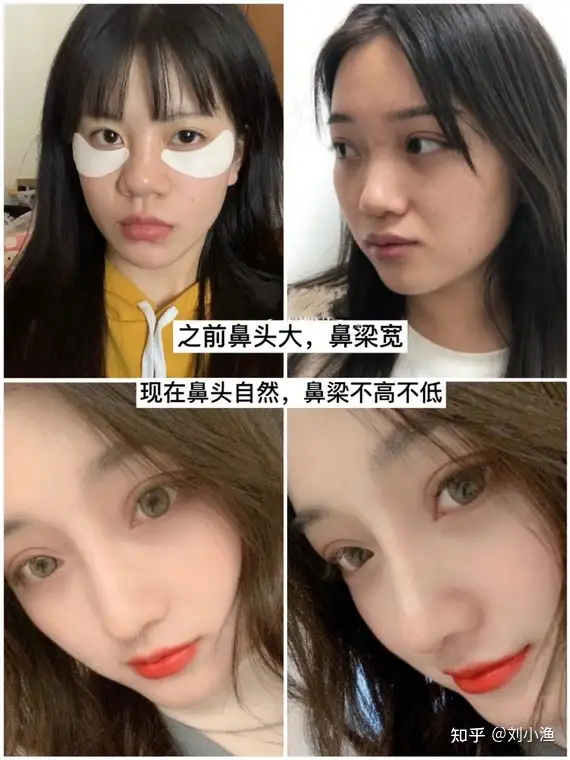 隆 必看 如何选择适合自己的鼻型 知乎 隆 必看 如何选择适合自己的鼻型 知乎