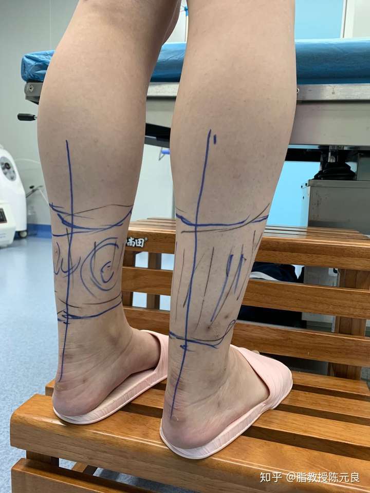 瘦小腿打瘦腿针还是抽脂好?