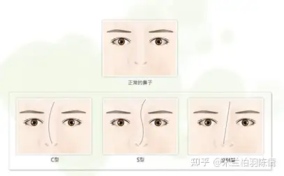 什么是歪鼻 歪鼻应该怎么来矫正 知乎