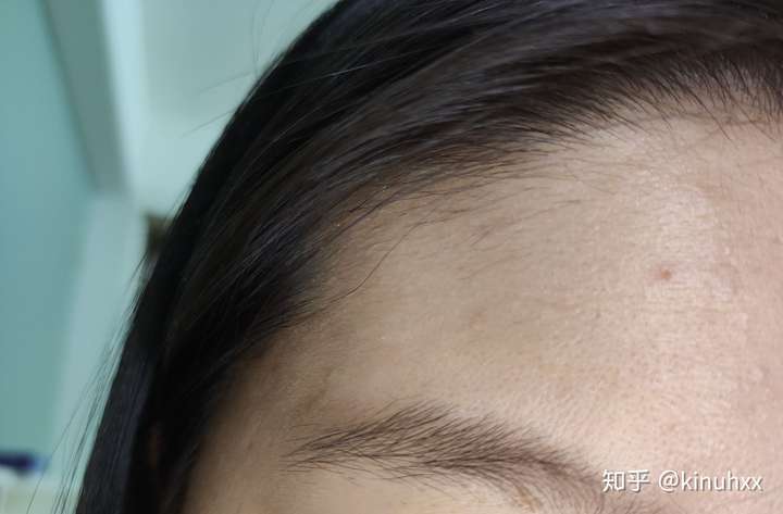 额头上长了许多毛发怎么办