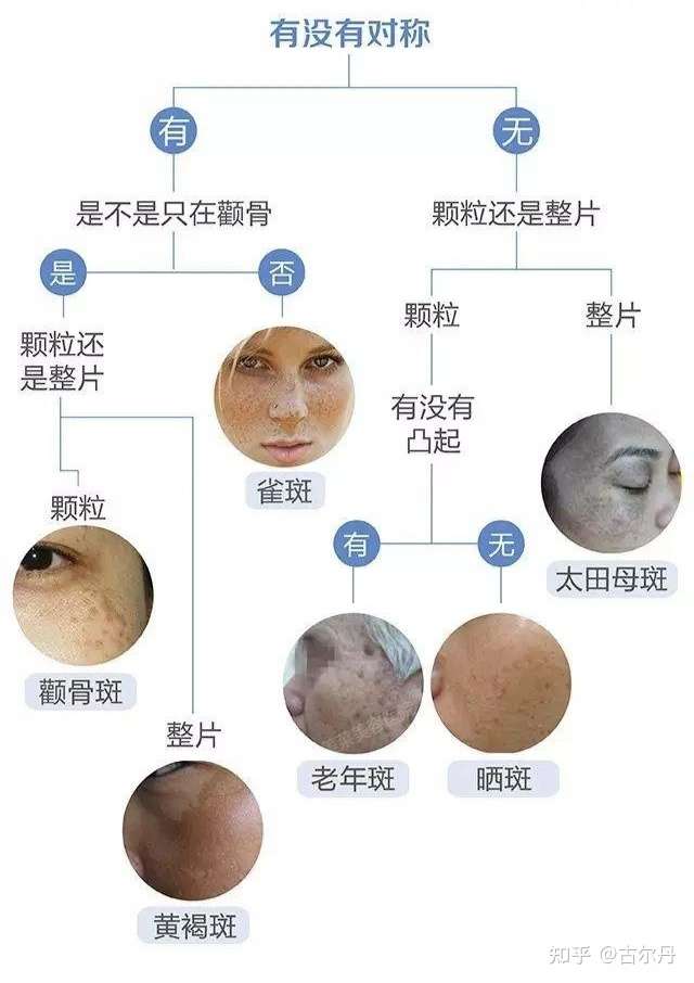 激光祛斑容易复发吗 知乎