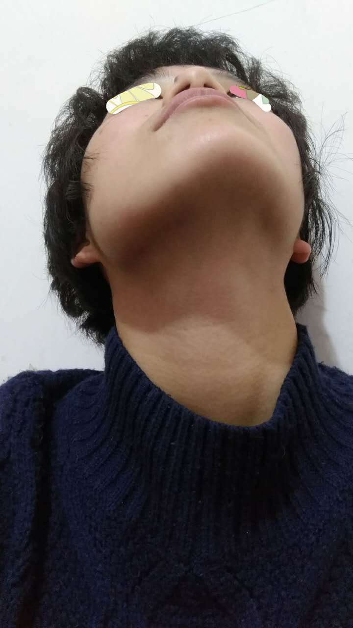 我下巴被人撞我感觉肌肉并不痛但我嘴张开最多放下1根手指我怀疑是不