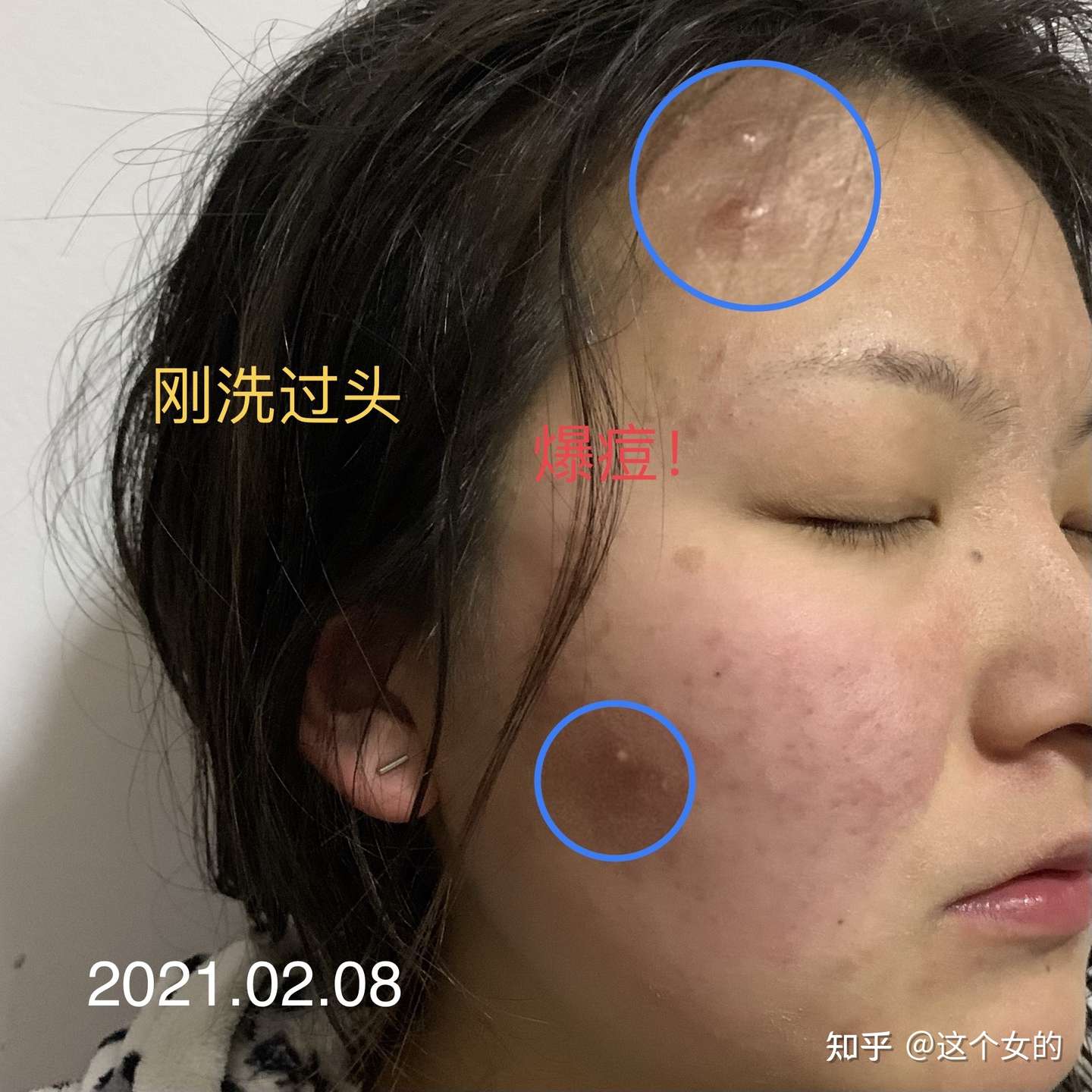 异维a酸停药半年多后复发 真正的勇士就是再吃一次 持续更新 知乎