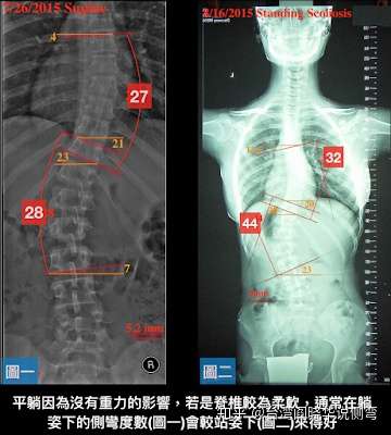 脊柱侧弯个案报告43 5度到26度 知乎