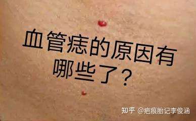 血管痣的原因有哪些了