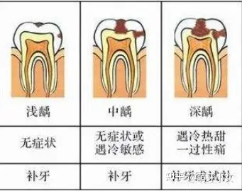 我们通常根据龋坏的程度如果对牙髓造成了感染的情况下需要进行根管