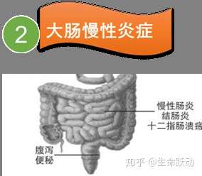 关注肿瘤康复 造福人类健康 肠癌 知乎