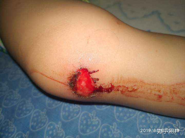 膝盖摔伤破了一大块皮流水抹云南白药好了一点三天后开始流水了咋办呢