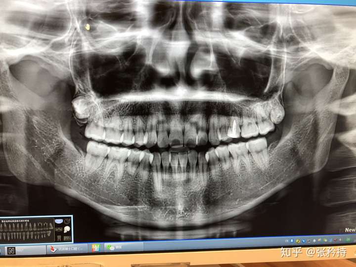 市口腔挂了两个号,一个普通一个专家,普通的跟我说我的牙根短,门牙