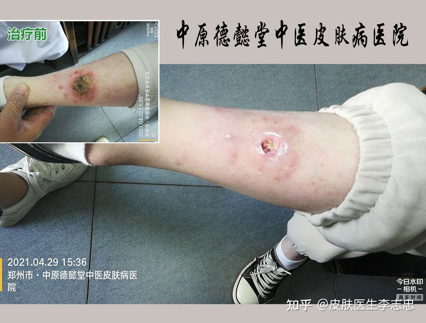 皮膚醫生李志忠 的想法: 溼疹,糜爛滲出結痂,用藥一週,明顯好轉!