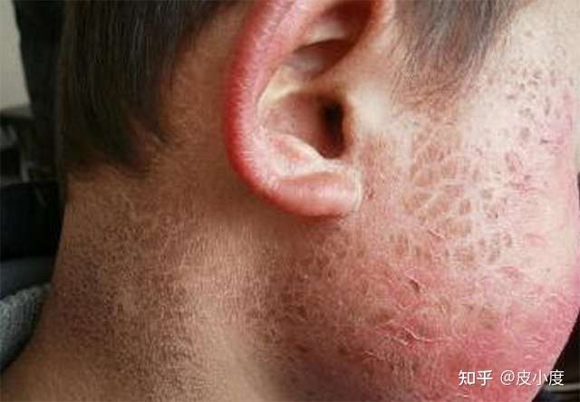 生来满身 鱼鳞 是病 知乎