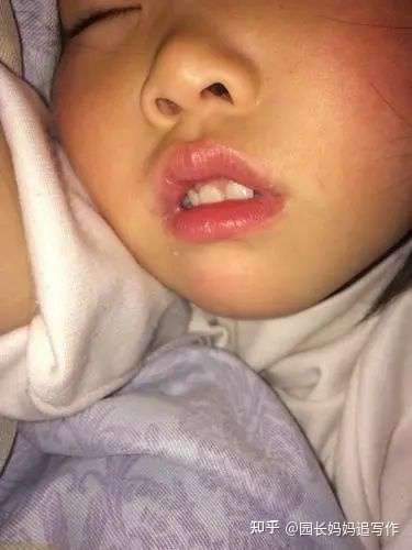 孩子晚上张嘴睡觉有必要给孩子用儿童口呼吸矫正贴纸吗