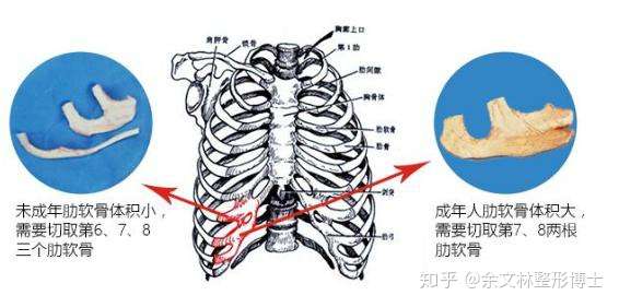 耳再造手术中的肋软骨造耳 到底要用多少肋软骨 知乎