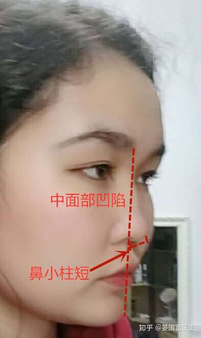 其实题主的山根,鼻梁的基础还是吧的,整个鼻子显得比较小,比较秀气