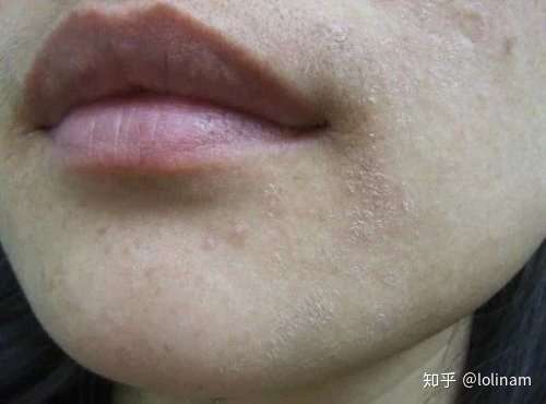 为什么脸上会脱皮