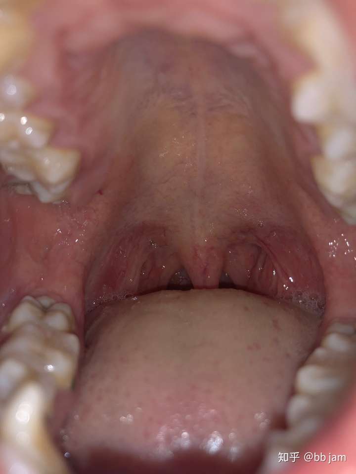 记录我的扁桃体摘除手术全过程