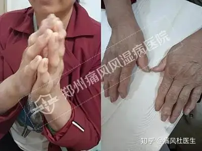 類風溼病友們可知如何預防手指變形