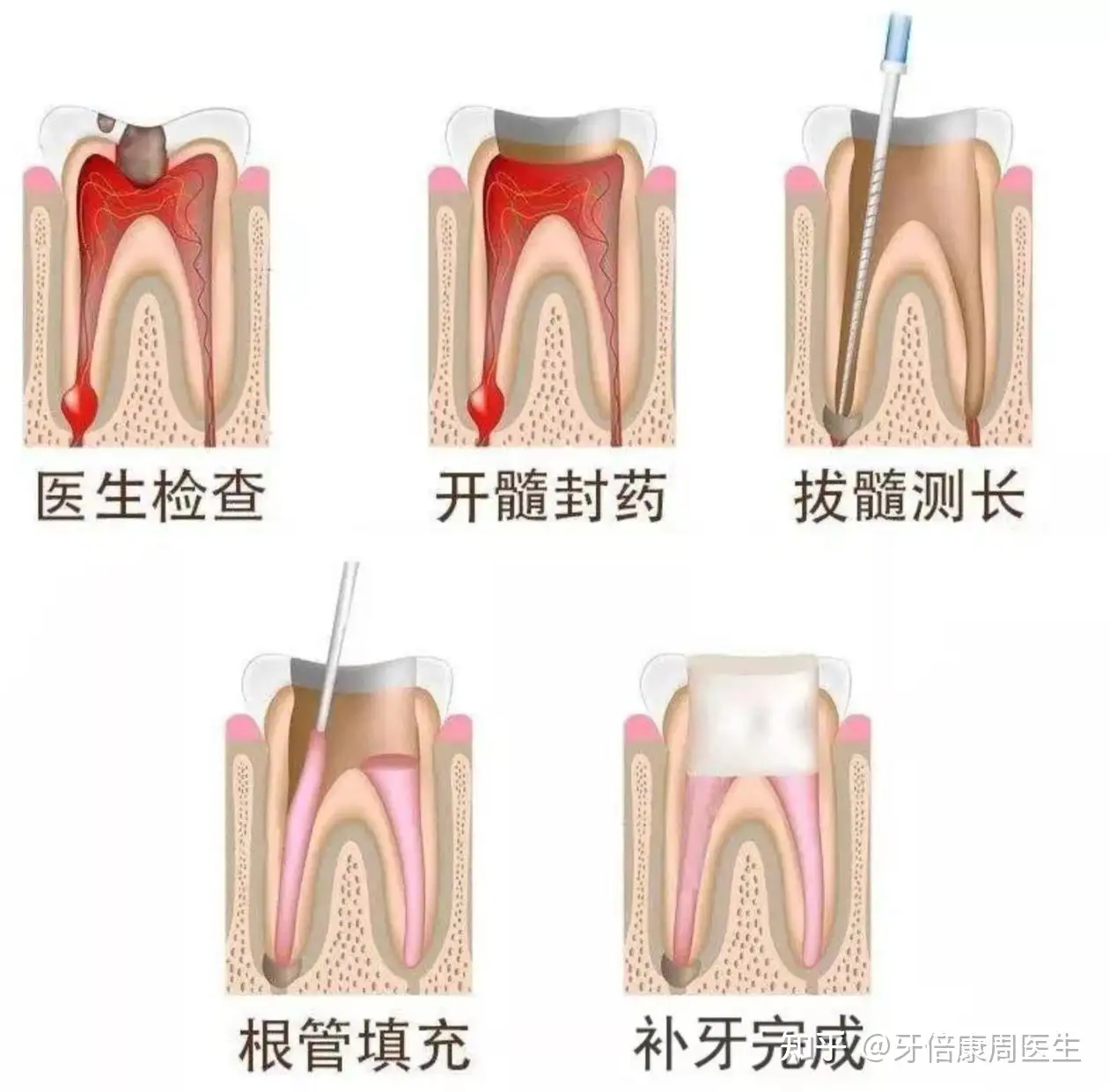 牙 髓 炎 自 愈