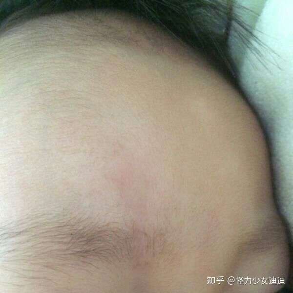 这样小刀划伤会留疤吗