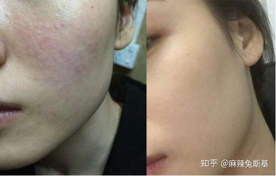 长期角质层薄怎么修复? - 知乎