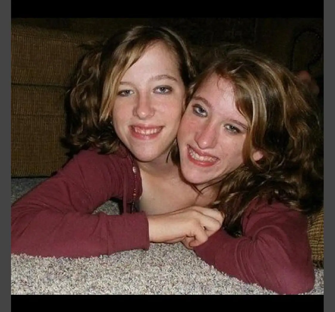 Conjoined twins Abby and Brittany Hensel the chances of survival