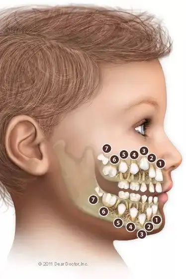 特殊的六龄齿需要特别的爱窝沟封闭