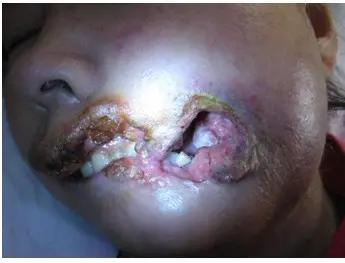 口腔癌术后脸部照图片